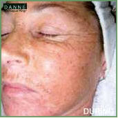 Danne skin therapy beauty acne anti aging Environ pigmentation