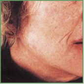 Danne skin therapy beauty acne anti aging Environ pigmentation scar